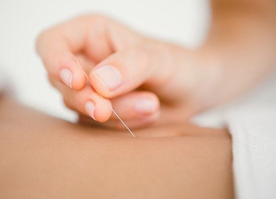 Dry Needling